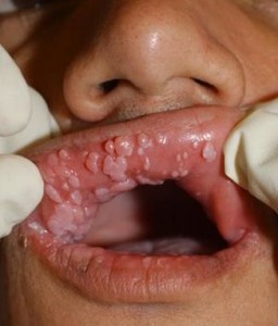 Virus del papiloma humano verrugas en la boca, - Verrugas de papiloma en la boca