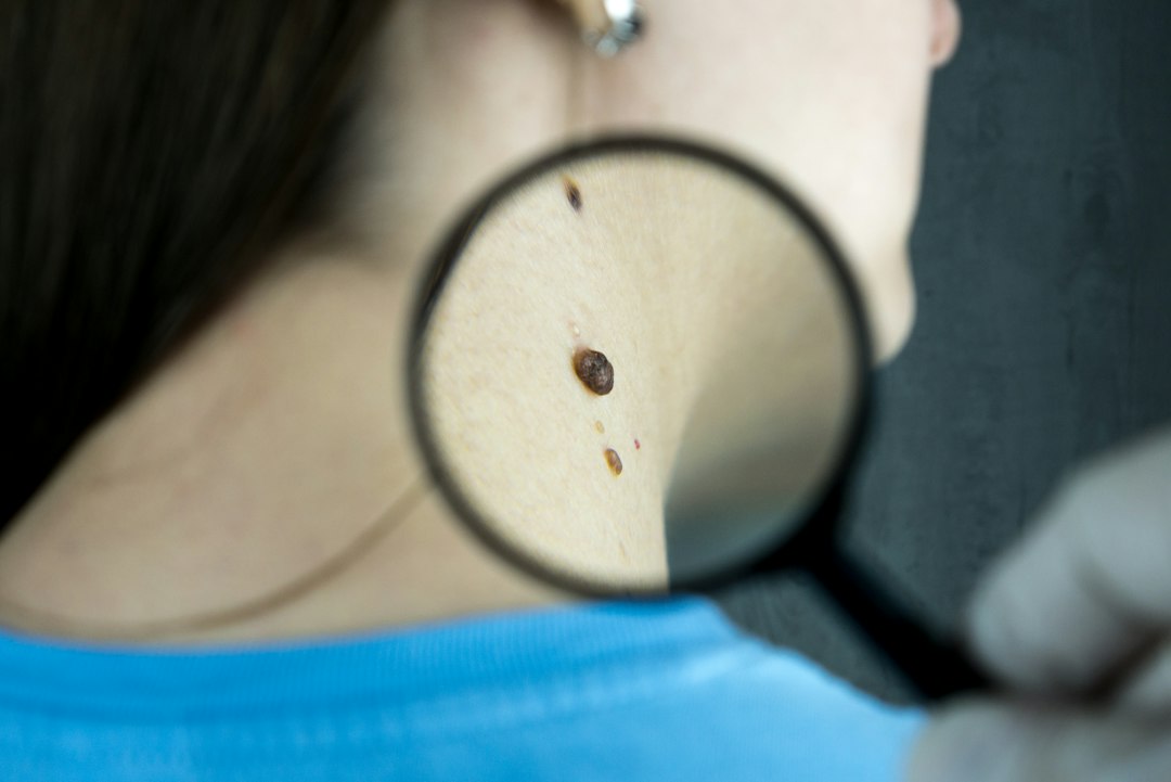 Imagen educativa sobre Verrugas por VPH: remedios, tratamientos y precauciones